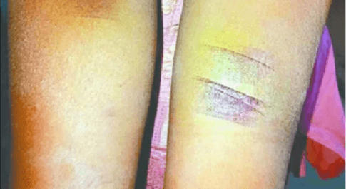 युवक ने पार की जुल्म की हद, पत्नी को जिंदा जलाने की की कोशिश