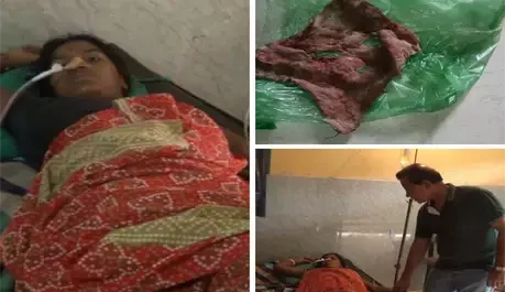 डॉक्टर की लापरवाही आई सामने, दो वर्ष बाद निकाला गया महिला के पेट से तौलिया